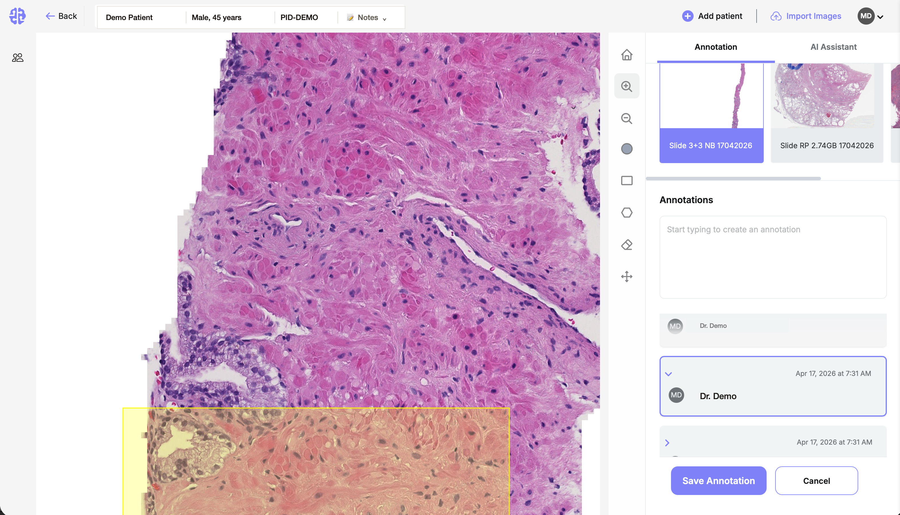 PathMDAi reviewer surface — whole-slide pathology viewer with annotation panel and AI Assistant